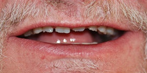 Closeup of smile with broken front tooth