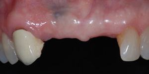 Closeup of two missing teeth