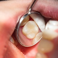 Dental mirror showing subtle appearance of tooth-colored filling
