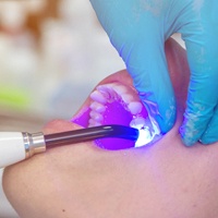Dentist using curing lamp to harden composite resin filling