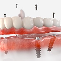 Illustration of implant dentures for lower arch