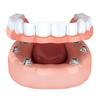 Model of upper implant denture