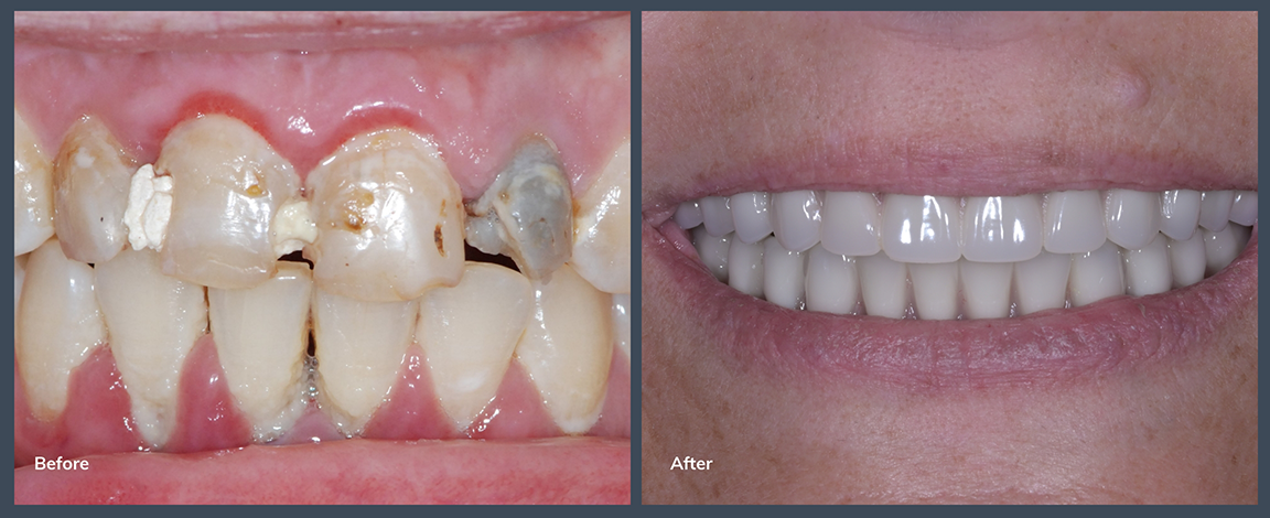 Close up of a smile before and after transformation from dentist in Allen
