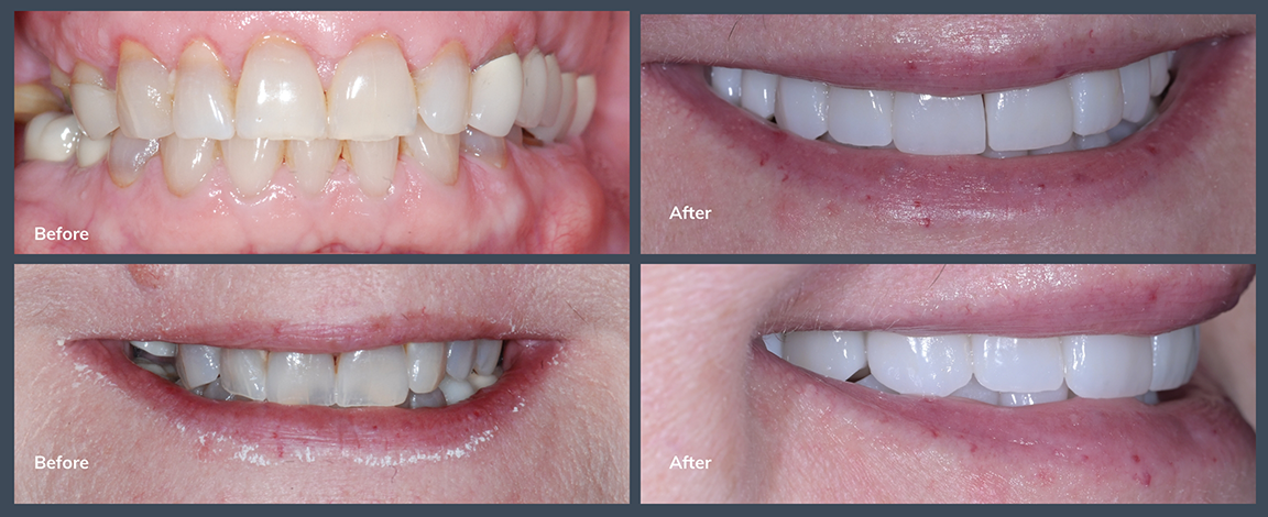 Smile before and after treating slightly discolored teeth