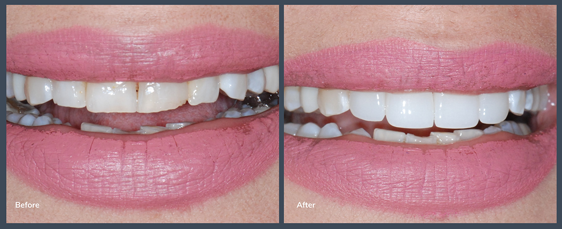 Smile before and after treating slightly chipped and stained teeth