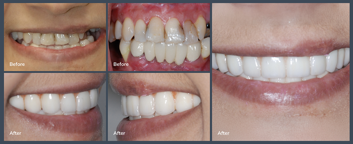 Person smiling before and after correcting misaligned and discolored teeth