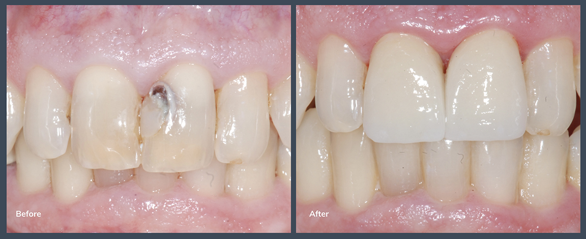 Close up of a smile before and after treating a discolored and damaged front tooth