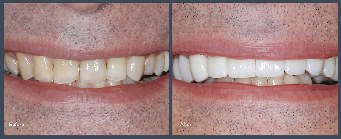 Smile before and after whitening the teeth