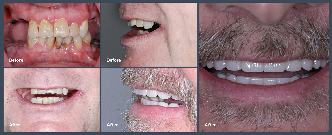 Man smiling before and after replacing multiple missing and damaged teeth
