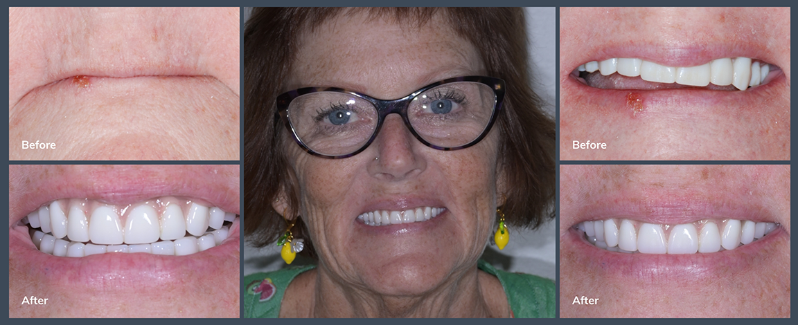 Woman smiling before and after treatment from prosthodontist