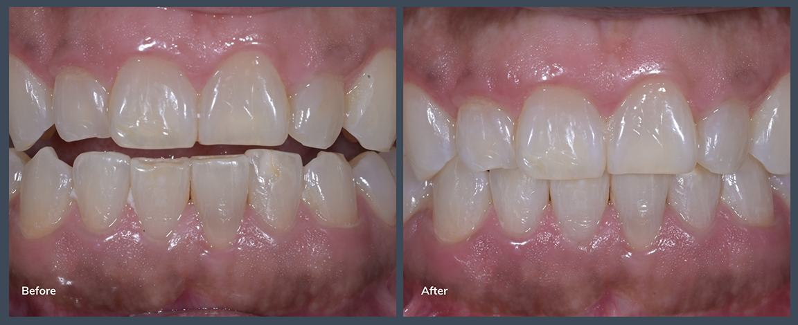 Smile before and after treating slightly misaligned teeth