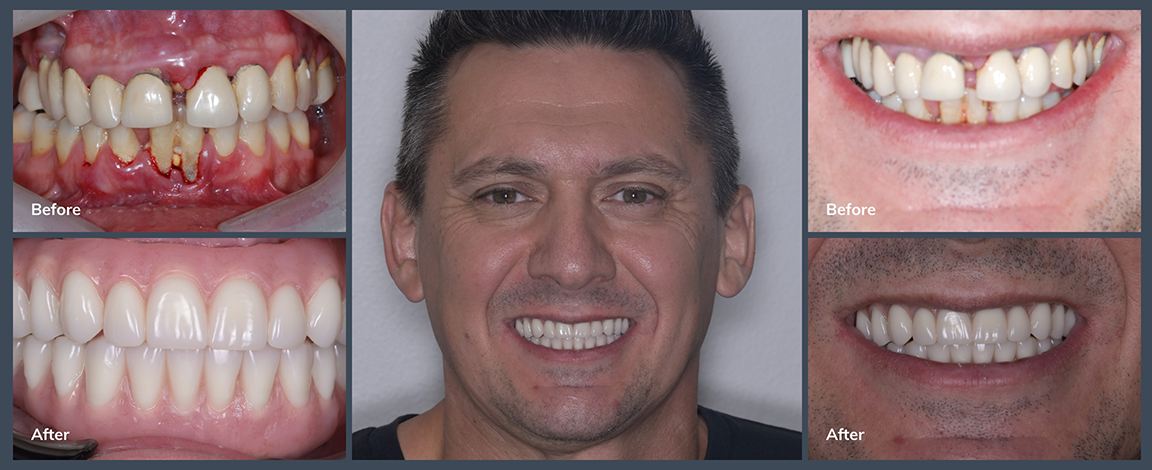 Man smiling before and after restoring several damaged and gapped teeth
