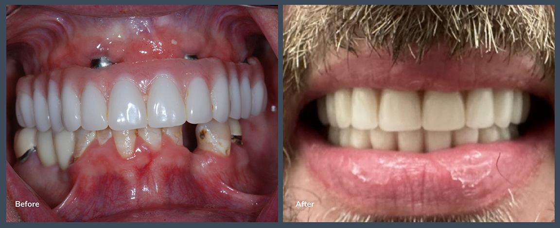 Smile before and after getting an implant denture