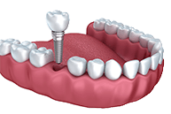Animation of implant supported crown