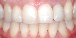 Closeup of healthy teeth and gums after treatment