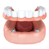 Animation of implant overdenture