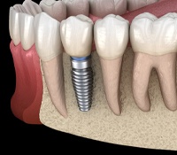 Illustration of implant successfully integrated with surrounding bone