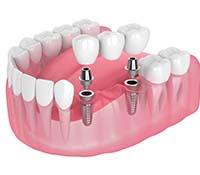 Illustration of three-unit dental implant bridge against white background