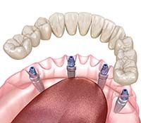 Implant denture for lower arch being attached to four dental implants
