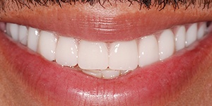Closeup of healthy teeth and gums after treatment
