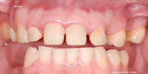 Closeup of teethwithdark coloring and decayaround gums