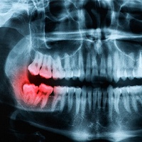 X-Ray taken in preparation for wisdom tooth extractions in Allen
