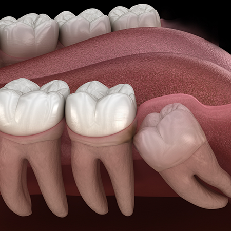 Illustration of an impacted wisdom tooth pressing against the adjacent tooth