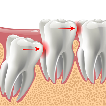 Illustrated impacted wisdom tooth pushing against the adjacent tooth