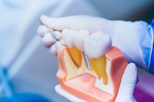 specialist explaining dental implants