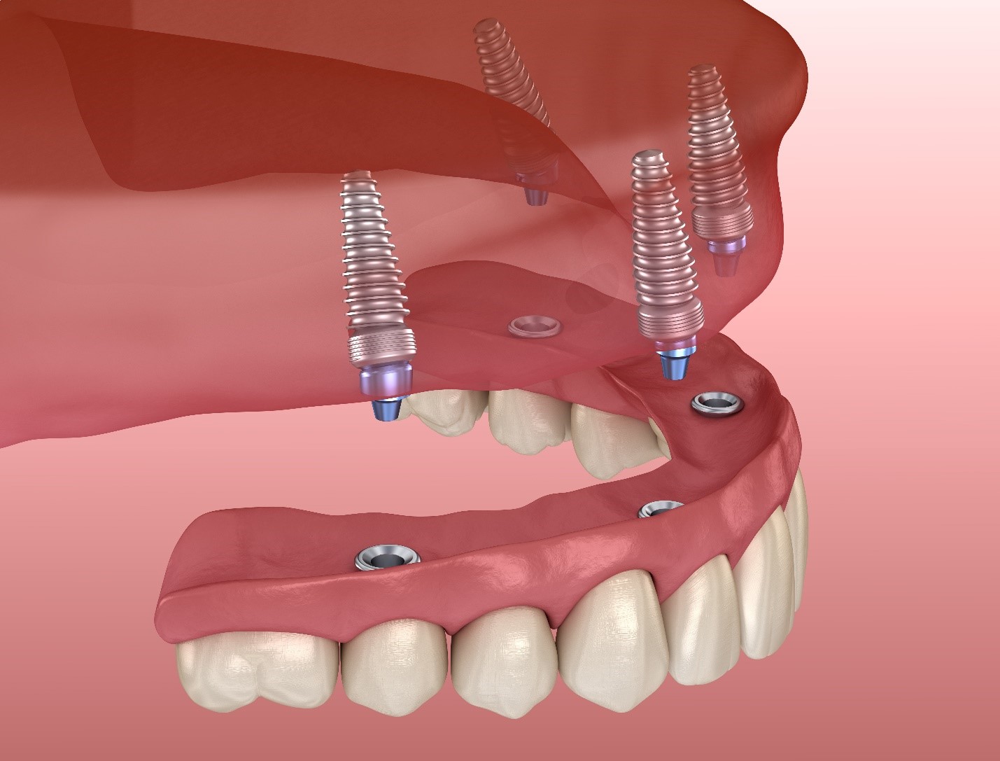 Can Your Teeth be Repaired or do you Need Dental Implants?