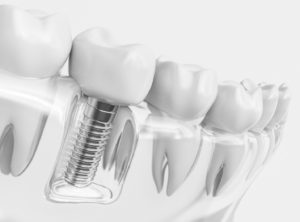 dental implant and crown in transparent jaw model