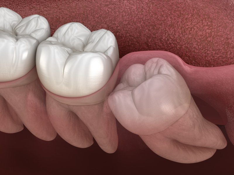 a digital image of an impacted wisdom tooth