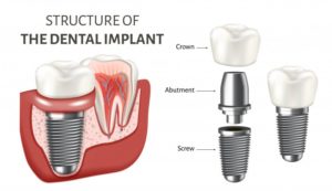 illustration of dental implant