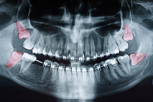 X-ray of four impacted wisdom teeth in jaw